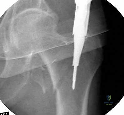 عملية الحفر لإدخال المسمار العنقي