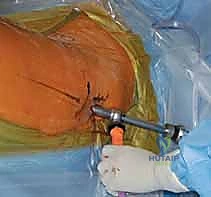 صورة توضيحية لـ التسمير النخاعي الرأسي الفخذي لكسور الفخذ القريب: دليل شامل للمرضى