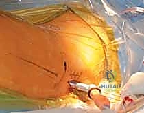 إدخال المسمار اللولبي في رأس الفخذ