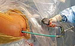 صورة توضيحية لـ التسمير النخاعي الرأسي الفخذي لكسور الفخذ القريب: دليل شامل للمرضى