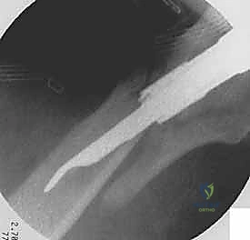 حفر العظم للمسامير السفلية