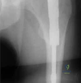 صورة توضيحية لـ التسمير النخاعي الرأسي الفخذي لكسور الفخذ القريب: دليل شامل للمرضى