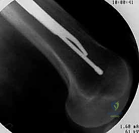 صورة طبية: التسمير النخاعي الرأسي الفخذي لكسور الفخذ القريب: دليل شامل للمرضى
