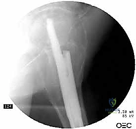 إدخال المسمار السفلي الأول