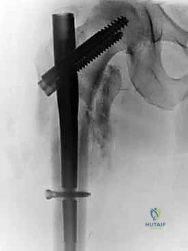 صورة توضيحية لـ التسمير النخاعي الرأسي الفخذي لكسور الفخذ القريب: دليل شامل للمرضى