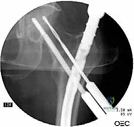 صورة توضيحية لـ التسمير النخاعي الرأسي الفخذي لكسور الفخذ القريب: دليل شامل للمرضى