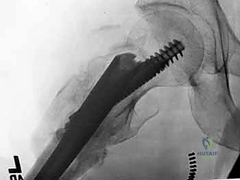 صورة توضيحية لـ التسمير النخاعي الرأسي الفخذي لكسور الفخذ القريب: دليل شامل للمرضى
