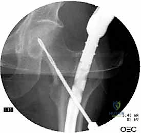 استخدام الأداة الموجهة للمسامير السفلية