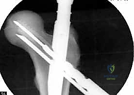 إدخال المسمار السفلي الثاني