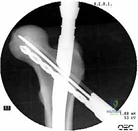 إغلاق الشقوق الجراحية