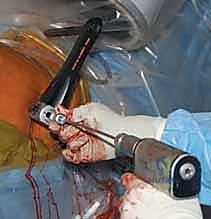 إدخال المسمار النخاعي الرئيسي