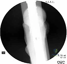 صورة طبية: التسمير النخاعي الرأسي الفخذي لكسور الفخذ القريب: دليل شامل للمرضى