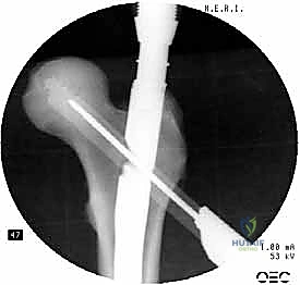إزالة أدوات التوجيه