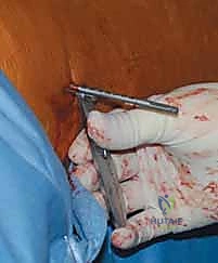 Illustration of femoral head fixation - Dr. Mohammed Hutaif