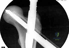 التأكد من التثبيت النهائي بالأشعة السينية