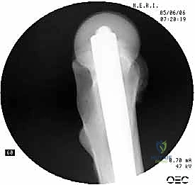 صورة جانبية للتثبيت النهائي