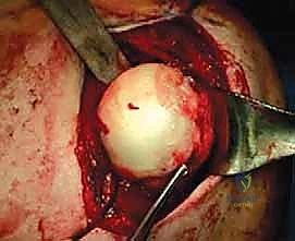 علاج آفة هيل ساكس المتشابكة: إعادة بناء مفصل الكتف بالطعوم العظمية لاستقرار دائم مع الأستاذ الدكتور محمد هطيف