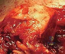 آلية حدوث آفة هيل ساكس والاصطدام الميكانيكي في مفصل الكتف