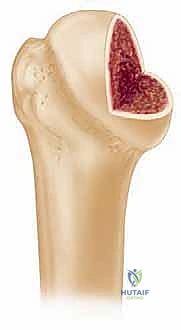 التحضير الجراحي وتخطيط موقع الطعم العظمي في رأس العضد