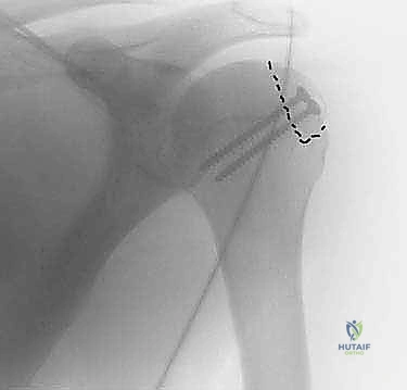 مرحلة التعافي وإعادة التأهيل بعد جراحة ترقيع آفة هيل ساكس