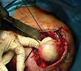 تثبيت الطعم العظمي بالبراغي الطبية الدقيقة لاستعادة استقرار الكتف