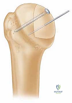 عملية تشكيل وزراعة الطعم العظمي لملء العيب في رأس العضد