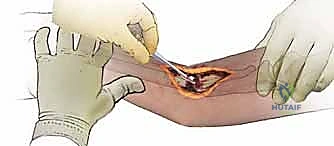 صورة توضيحية لـ فهم وعلاج عدم التئام كسور الساعد: دليل شامل للمرضى مع الأستاذ الدكتور محمد هطيف