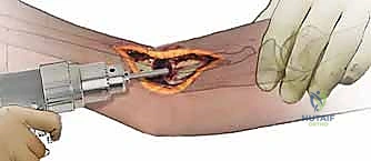 صورة توضيحية لأنواع عدم التئام كسور الساعد والفرق بينها