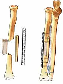 Illustration of treatment of radius - Dr. Mohammed Hutaif