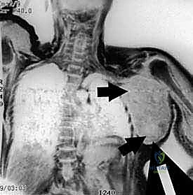 إعادة البناء باستخدام المفاصل الصناعية