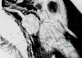 الشق الجراحي والتعامل مع الأنسجة