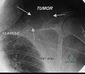 مقارنة بين خيارات العلاج الجراحي
