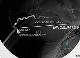 التشريح الجراحي لحزام الكتف