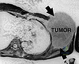 استئصال حزام الكتف: دليل شامل لجراحة الأورام الخبيثة والحفاظ على الطرف مع الأستاذ الدكتور محمد هطيف في صنعاء