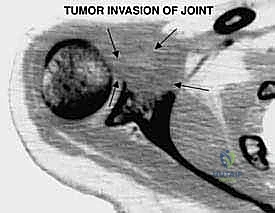 أنواع الأورام التي تصيب منطقة الكتف