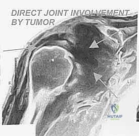 الأعراض السريرية لأورام الكتف