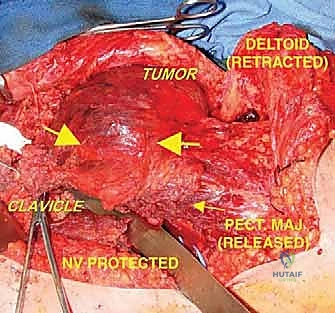 تغطية الجرح وإغلاق الأنسجة
