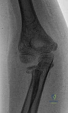 كسور عنق الكعبرة عند الأطفال: دليل شامل للتشخيص والعلاج المتقدم مع الأستاذ الدكتور محمد هطيف في صنعاء