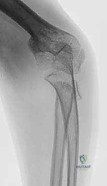 كسر عنق الكعبرة يمر عبر صفيحة النمو