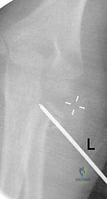 صورة توضيحية لـ كسور عنق الكعبرة عند الأطفال: دليل شامل للتشخيص والعلاج المتقدم مع الأستاذ الدكتور محمد هطيف في صنعاء