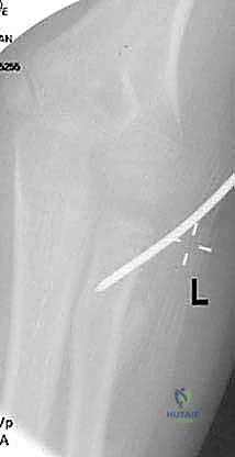 تصنيف الكسور بالأشعة