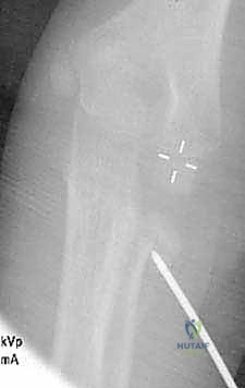 صورة طبية: كسور عنق الكعبرة عند الأطفال: دليل شامل للتشخيص والعلاج المتقدم مع الأستاذ الدكتور محمد هطيف في صنعاء