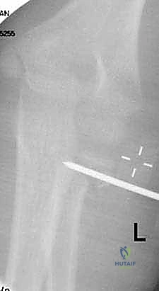 إدخال سلك كيرشنر