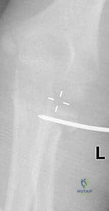 الرد المغلق للكسر