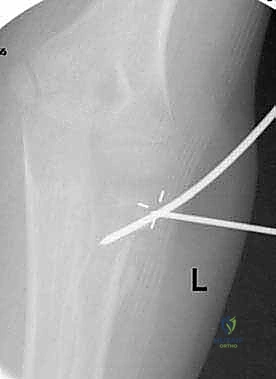 الأشعة السينية لكسر عنق الكعبرة