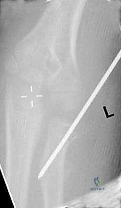 صورة طبية: كسور عنق الكعبرة عند الأطفال: دليل شامل للتشخيص والعلاج المتقدم مع الأستاذ الدكتور محمد هطيف في صنعاء