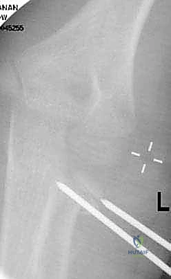 صورة توضيحية لـ كسور عنق الكعبرة عند الأطفال: دليل شامل للتشخيص والعلاج المتقدم مع الأستاذ الدكتور محمد هطيف في صنعاء