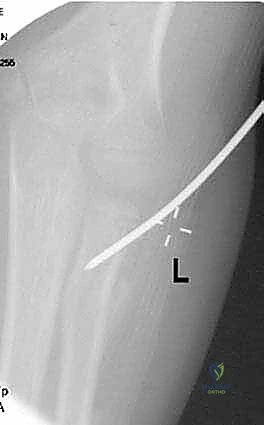 حماية العصب أثناء التدخل الجراحي