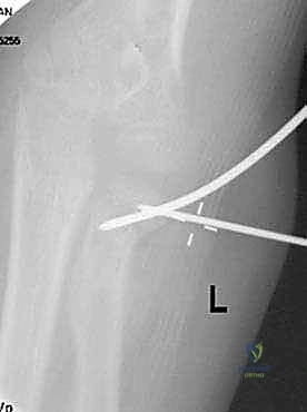 صورة طبية: كسور عنق الكعبرة عند الأطفال: دليل شامل للتشخيص والعلاج المتقدم مع الأستاذ الدكتور محمد هطيف في صنعاء