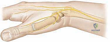 تقنية المسامير النخاعية المرنة